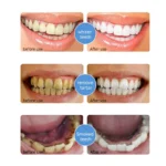 Nano-Hydroxyapatite-Toothpaste-6