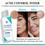 Tonico anti-acne